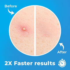 Pimple Patches for Face (240 Patches), Hydrocolloid Acne Patches with Tea Tree Oil, Pimple Stickers - Acne Pimple Patches for Face - Zit Patches